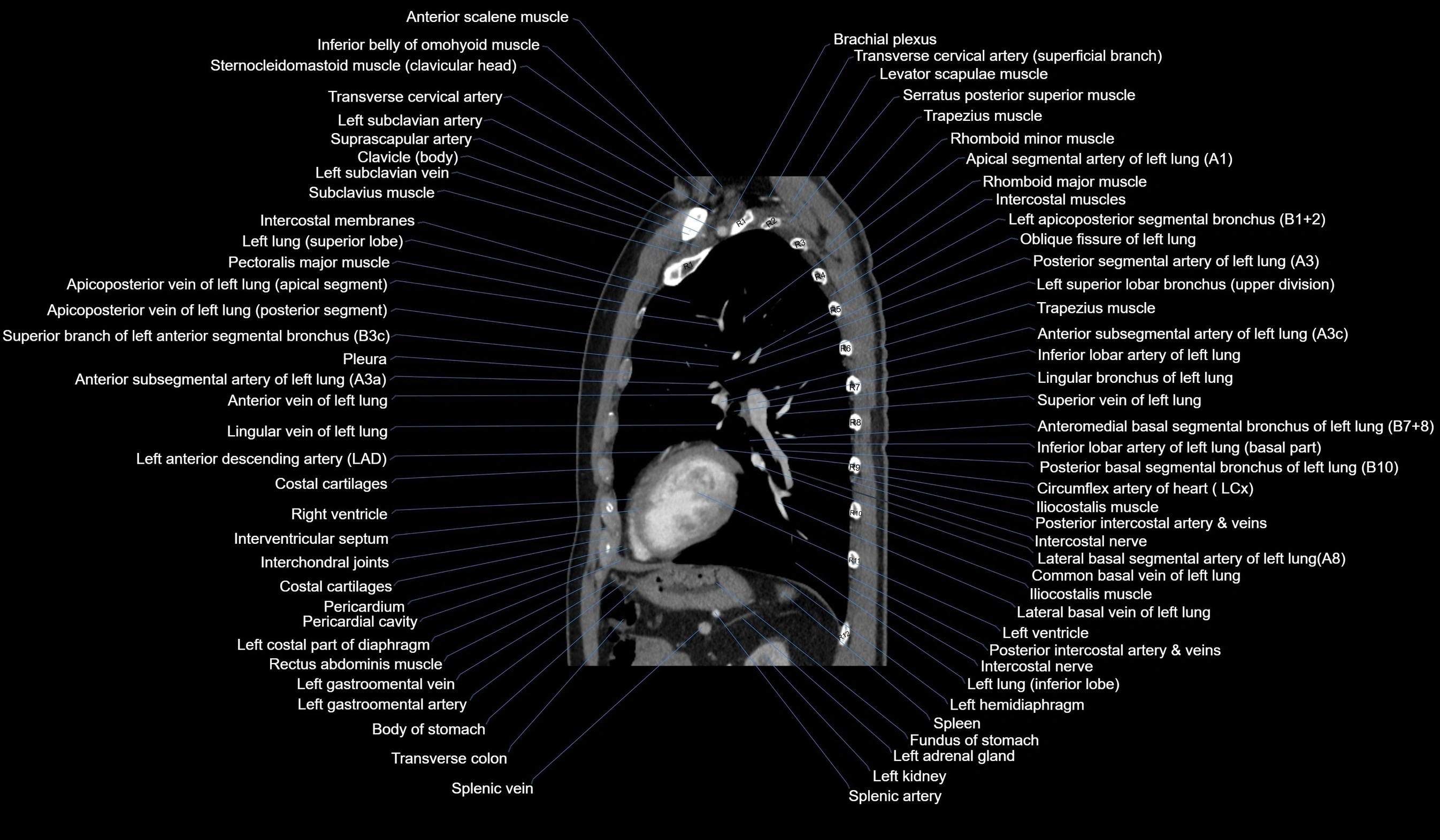CT chest (thorax) labelled sagittal cross sectional anatomy radiology image-00095.webp